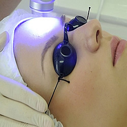 despigmentação laser sobrancelhas