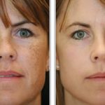 Micropigmentação ajuda a disfarçar manchas de pele