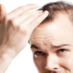 Tratamento para queda de cabelo – Biomédico Invasivo não Cirúrgico