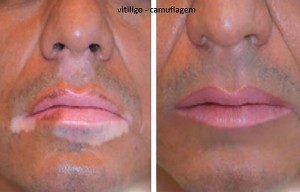 foto-vitiligo